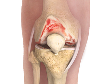 Knee Osteoarthritis