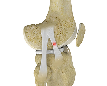 Knee Sprain