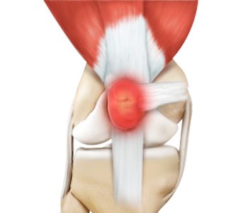 Kneecap Bursitis