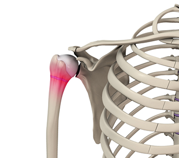 Little League Shoulder