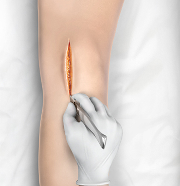 Minimally Invasive Knee Joint Replacement