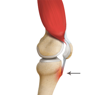 Osgood Schlatter Disease