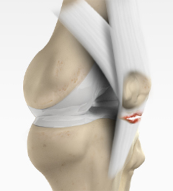 Patellar Tendon Rupture