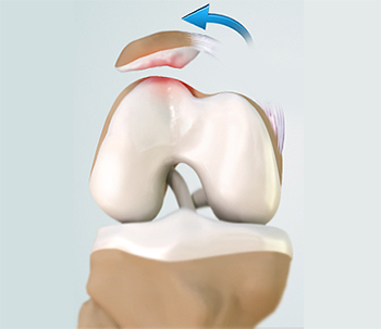 Patellofemoral Instability