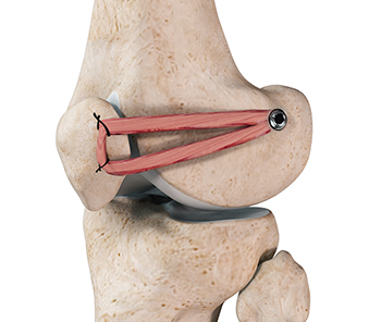 Patellofemoral Knee Replacement