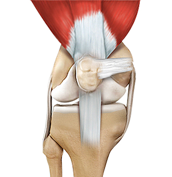 Quadriceps Tendon Repair