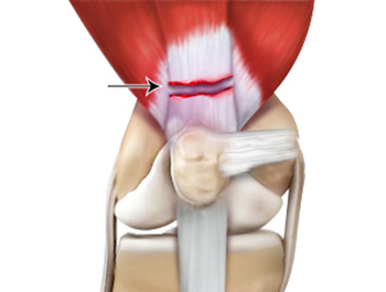 Quadriceps Tendon Rupture