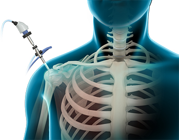 Shoulder Arthroscopy
