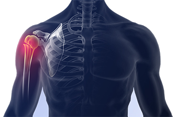 Shoulder Fracture
