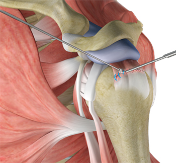 Shoulder Stabilization