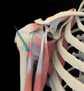 Shoulder Tendonitis