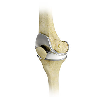 Total Knee Replacement