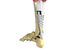 Cerebral Palsy Treatment