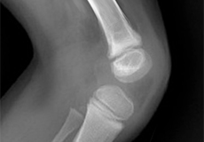 Congenital Absent Patella