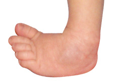 Congenital Deformity and Clubfoot
