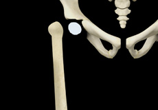 Congenital Femoral Deficiency