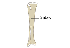 Congenital Knee Fusion