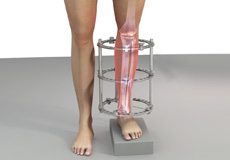 Congenital Limb Length Discrepancies