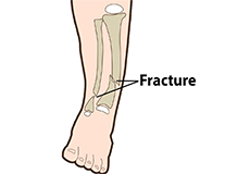 Congenital Pseudoarthrosis of the Tibia