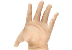 Diastrophic Dysplasia