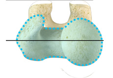 Femoral Retroversion