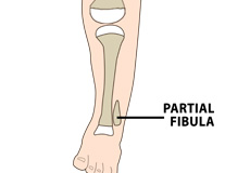 Fibular Hemimelia