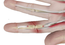Flexor Tendon Injuries