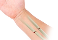 Forearm Fractures in Children