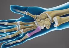 Fractures of the Hand and Fingers