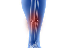Tibia Fractures in Children