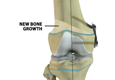 Guided Growth for Deformity Correction