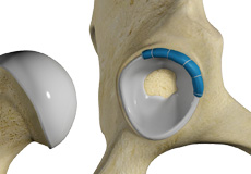 Hip Trauma Reconstruction