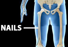 Intramedullary Nailing