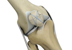 Knee Fracture Surgery
