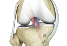 Ligament Reconstruction