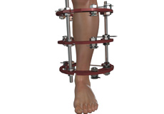 Lower Limb Deformity Correction