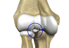 Loose Bodies in the Elbow