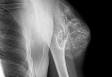 Multiple Hereditary Exostosis (Osteochondromas)