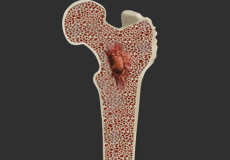 Genetic Diseases with Musculoskeletal Problems