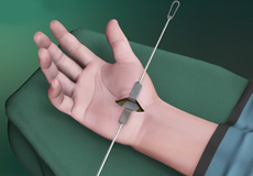 Open Carpal Tunnel Release Surgery