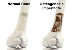 Osteogenesis Imperfecta