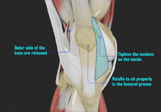 Patellofemoral Realignment