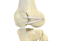 Patellofemoral Stabilisation