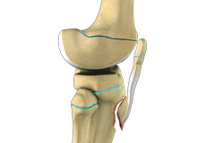 Pediatric Tibial Tubercle Fractures