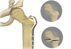 Proximal Femoral Focal Deficiency