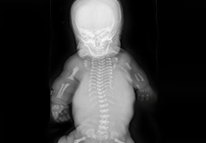 Skeletal Dysplasias