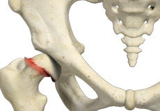 Slipped Capital Femoral Epiphysis