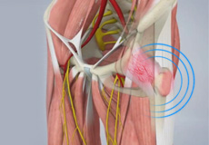 Snapping Hip Syndrome