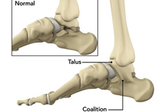 Tarsal Coalition