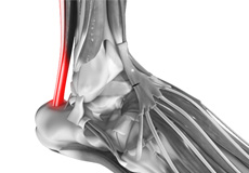 Tendinopathies